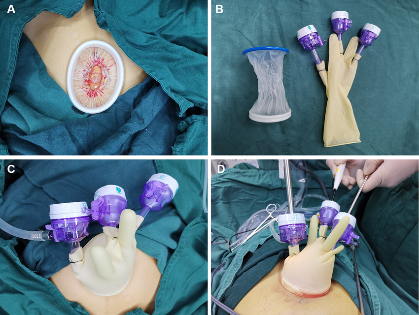Disposable Incision Protection Sleeve ( Wound Protector ) How to use